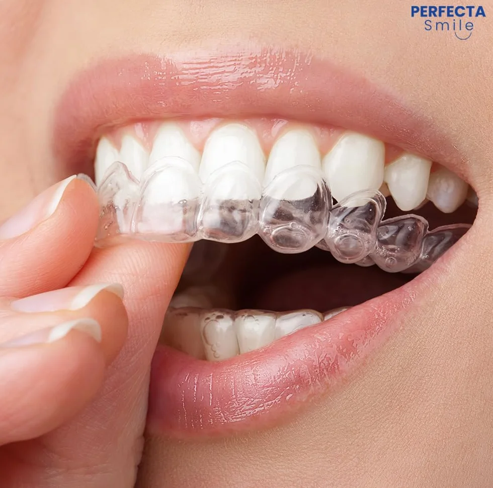 Boston Tech Lot de 10 attelles dentaires pour bruxisme nocturne | Protège-dents pour combler et serrer les dents | Ajustement personnalisé | Utilisation pour le sommeil et le sport | Sans BPA | Étui